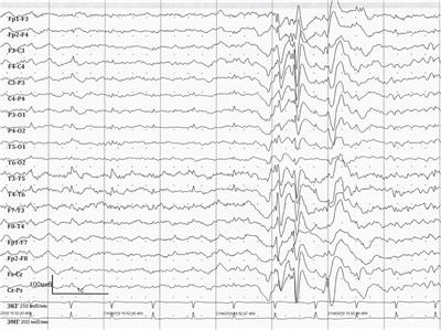 Case report: Adult patient with WWOX developmental and epileptic encephalopathy: 40 years of observation